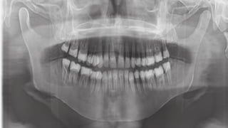 Opg Radiology Orthopantomogram (OPG) Panoramic X-ray Imaging in Dentistry | PPTX