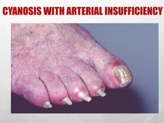 CYANOSIS WITH ARTERIAL INSUFFICIENCY
SHAHZAD BASHIR,
NLCON, KARACHI.
26
 