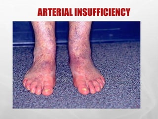 ARTERIAL INSUFFICIENCY
27
 