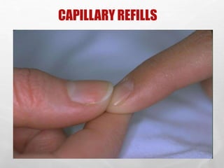 CAPILLARY REFILLS
SHAHZAD BASHIR,
NLCON, KARACHI.
2/26/2016 28
 