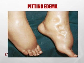 PITTINGEDEMA
SHAHZAD BASHIR,
NLCON, KARACHI.
2/26/2016 29
 