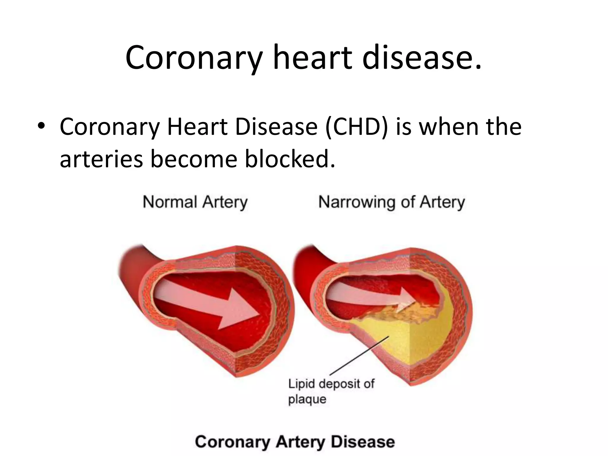Coronary heart disease.
• Coronary Heart Disease (CHD) is when the
arteries become blocked.
 