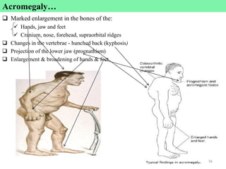 Acromegaly…
 Marked enlargement in the bones of the:
 Hands, jaw and feet
 Cranium, nose, forehead, supraorbital ridges
 Changes in the vertebrae - hunched back (kyphosis)
 Projection of the lower jaw (prognathism)
 Enlargement & broadening of hands & feet
56
56
 