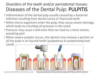 http://www.tpub.com/content/medical/14274/css/14274_86.htm
Disorders of the teeth and/or periodontal tissues:
Diseases of the Dental Pulp: PULPITIS
• Inflammation of the dental pulp usually caused by a bacterial
infection resulting from dental caries or fractured teeth
• When micro-organisms enter the pulp, they cause severe damage,
which leads to a buildup of pressure in the canal
• Pressure may cause a dull ache that can lead to a more severe,
pulsating pain
• When severe pulpitis occurs, the dentist may remove a portion or
all the pulp in an injured tooth (pulpotomy or pulpectomy/root
canal)
This Photo by Unknown Author is licensed under CC BY-SA
Updated 2018 E Dilgert 22
 