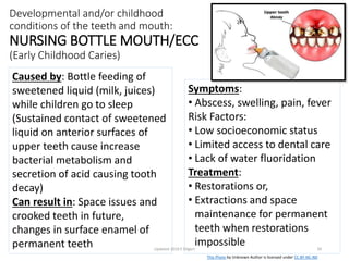Developmental and/or childhood
conditions of the teeth and mouth:
NURSING BOTTLE MOUTH/ECC
(Early Childhood Caries)
Symptoms:
• Abscess, swelling, pain, fever
Risk Factors:
• Low socioeconomic status
• Limited access to dental care
• Lack of water fluoridation
Treatment:
• Restorations or,
• Extractions and space
maintenance for permanent
teeth when restorations
impossible
Caused by: Bottle feeding of
sweetened liquid (milk, juices)
while children go to sleep
(Sustained contact of sweetened
liquid on anterior surfaces of
upper teeth cause increase
bacterial metabolism and
secretion of acid causing tooth
decay)
Can result in: Space issues and
crooked teeth in future,
changes in surface enamel of
permanent teeth Updated 2018 E Dilgert 34
This Photo by Unknown Author is licensed under CC BY-NC-ND
 