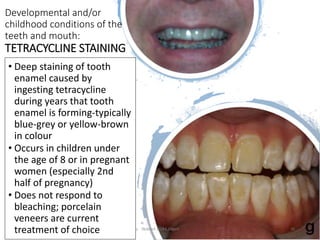 Developmental and/or
childhood conditions of the
teeth and mouth:
TETRACYCLINE STAINING
• Deep staining of tooth
enamel caused by
ingesting tetracycline
during years that tooth
enamel is forming-typically
blue-grey or yellow-brown
in colour
• Occurs in children under
the age of 8 or in pregnant
women (especially 2nd
half of pregnancy)
• Does not respond to
bleaching; porcelain
veneers are current
treatment of choice Updated 2018 E Dilgert 35
 