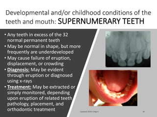 Developmental and/or childhood conditions of the
teeth and mouth: SUPERNUMERARY TEETH
• Any teeth in excess of the 32
normal permanent teeth
• May be normal in shape, but more
frequently are underdeveloped
• May cause failure of eruption,
displacement, or crowding
• Diagnosis: May be evident
through eruption or diagnosed
using x-rays
• Treatment: May be extracted or
simply monitored, depending
upon eruption of related teeth,
pathology, placement, and
orthodontic treatment Updated 2018 E Dilgert 36
 