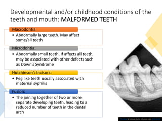 Developmental and/or childhood conditions of the
teeth and mouth: MALFORMED TEETH
37
• Abnormally large teeth. May affect
some/all teeth
Macrodontia:
• Abnormally small teeth. If affects all teeth,
may be associated with other defects such
as Down’s Syndrome
Microdontia:
• Peg like teeth usually associated with
maternal syphilis
Hutchinson’s Incisors:
• The joining together of two or more
separate developing teeth, leading to a
reduced number of teeth in the dental
arch
Fusion:
This Photo by Unknown Author is licensed under CC BY-NC-ND
 