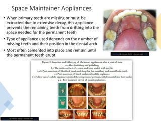 Space Maintainer Appliances
• When primary teeth are missing or must be
extracted due to extensive decay, this appliance
prevents the remaining teeth from drifting into the
space needed for the permanent teeth
• Type of appliance used depends on the number of
missing teeth and their position in the dental arch
• Most often cemented into place and remain until
the permanent teeth erupt
40
This Photo by Unknown Author is licensed under CC BY
This Photo by Unknown Author is licensed under CC BY
 