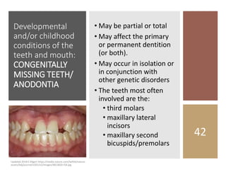 Developmental
and/or childhood
conditions of the
teeth and mouth:
CONGENITALLY
MISSING TEETH/
ANODONTIA
• May be partial or total
• May affect the primary
or permanent dentition
(or both).
• May occur in isolation or
in conjunction with
other genetic disorders
• The teeth most often
involved are the:
• third molars
• maxillary lateral
incisors
• maxillary second
bicuspids/premolars
42
Updated 2018 E Dilgert https://media.nature.com/lw926/nature-
assets/bdj/journal/v201/n2/images/4813820-f18.jpg
 