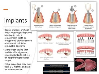 Implants
• Dental implant: artificial
tooth root surgically placed
into jaw to hold a
replacement tooth or
bridge or to provide secure
attachment points for
removable dentures
• More tooth-saving than
traditional bridgework,
since implants do not rely
on neighboring teeth for
support
• Entire procedure may take
from 3-9 months and can
be +++ expensive 46
This Photo by Unknown Author is licensed under CC BY-NC-ND
This Photo by Unknown Author is licensed under CC BY-NC-ND
This Photo by Unknown Author is licensed under CC BY
This Photo by Unknown Author is licensed under CC BY-NC-ND
 