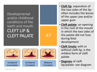 Developmental
and/or childhood
conditions of the
teeth and mouth:
CLEFT LIP &
CLEFT PALATE 47
• Cleft lip: separation of
the two sides of the lip-
often includes the bones
of the upper jaw and/or
upper gum
• Cleft palate: an opening
in the roof of the mouth
in which the two sides of
the palate did not fuse
during fetal
development
• Cleft Uvula: with or
without cleft lip, is the
mildest form of cleft
palate
• Degrees of cleft
lip/palate: see diagram
Updated 2018 E Dilgert
 