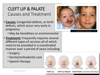 CLEFT LIP & PALATE
Causes and Treatment
• Causes: Congenital defects, or birth
defects, which occur very early in
pregnancy
• May be hereditary or environmental
• Treatment: Frequently requires several
different types of services all of which
need to be provided in a coordinated
manner over a period of years including:
• Surgery
• Dental/orthodontic care
• Speech therapy
Updated 2018 E Dilgert 48
This Photo by Unknown Author is licensed under CC BY-SA-NC
 