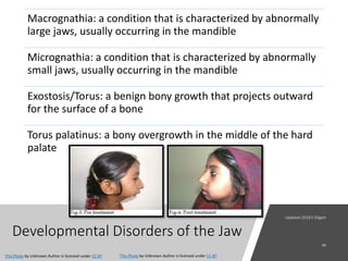 Developmental Disorders of the Jaw
Macrognathia: a condition that is characterized by abnormally
large jaws, usually occurring in the mandible
Micrognathia: a condition that is characterized by abnormally
small jaws, usually occurring in the mandible
Exostosis/Torus: a benign bony growth that projects outward
for the surface of a bone
Torus palatinus: a bony overgrowth in the middle of the hard
palate
This Photo by Unknown Author is licensed under CC BY
This Photo by Unknown Author is licensed under CC BY
 