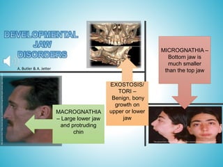 MICROGNATHIA –
Bottom jaw is
much smaller
than the top jaw
EXOSTOSIS/
TORI –
Benign, bony
growth on
upper or lower
jaw
MACROGNATHIA
– Large lower jaw
and protruding
chin
This picture from: https://www.studiodentaire.com/en/conditions/micrognatia.php
This picture from: https://www.jbsr.be/articles/10.5334/jbsr.1766/
This
picture
from:
http://www.drpulp.com/2013/06/micrognathia-types-causes-signs-and.html
A. Butler & A. Jetter
 