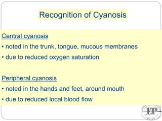 Central cyanosis
• noted in the trunk, tongue, mucous membranes
• due to reduced oxygen saturation
Peripheral cyanosis
• noted in the hands and feet, around mouth
• due to reduced local blood flow
Recognition of Cyanosis
 