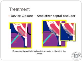Treatment
 Device Closure – Amplatzer septal occluder
During cardiac catheterization the occluder is placed in the
Defect
 