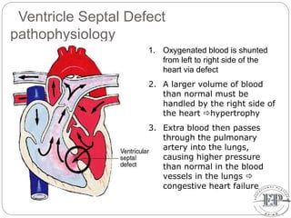 Ventricle Septal Defect
pathophysiology
1. Oxygenated blood is shunted
from left to right side of the
heart via defect
2. A larger volume of blood
than normal must be
handled by the right side of
the heart hypertrophy
3. Extra blood then passes
through the pulmonary
artery into the lungs,
causing higher pressure
than normal in the blood
vessels in the lungs 
congestive heart failure
 