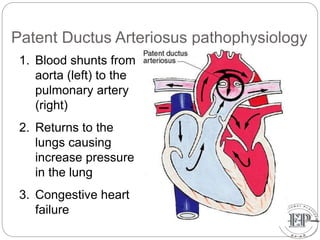 Patent Ductus Arteriosus pathophysiology
1. Blood shunts from
aorta (left) to the
pulmonary artery
(right)
2. Returns to the
lungs causing
increase pressure
in the lung
3. Congestive heart
failure
 