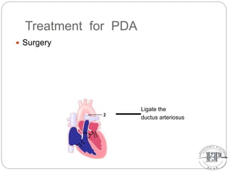 Treatment for PDA
 Surgery
Ligate the
ductus arteriosus
 
