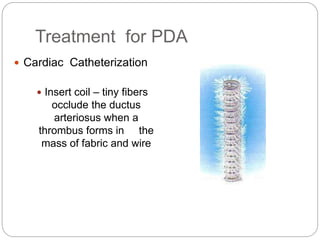 Treatment for PDA
 Cardiac Catheterization
 Insert coil – tiny fibers
occlude the ductus
arteriosus when a
thrombus forms in the
mass of fabric and wire
 