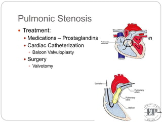 Pulmonic Stenosis
 Treatment:
 Medications – Prostaglandins to keep the PDA open
 Cardiac Catheterization
 Baloon Valvuloplasty
 Surgery
 Valvotomy
 