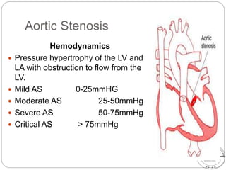Aortic Stenosis
Hemodynamics
 Pressure hypertrophy of the LV and
LA with obstruction to flow from the
LV.
 Mild AS 0-25mmHG
 Moderate AS 25-50mmHg
 Severe AS 50-75mmHg
 Critical AS > 75mmHg
 