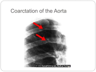 Coarctation of the Aorta
 