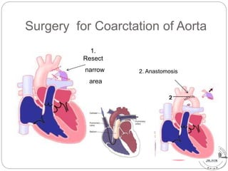 Surgery for Coarctation of Aorta
1.
Resect
narrow
area
2. Anastomosis
 