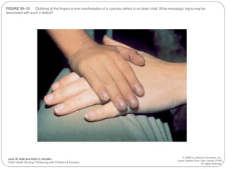 FIGURE 26–13 Clubbing of the fingers is one manifestation of a cyanotic defect in an older child. What neurologic signs may be
associated with such a defect?
Jane W. Ball and Ruth C. Bindler
Child Health Nursing: Partnering with Children & Families
© 2006 by Pearson Education, Inc.
Upper Saddle River, New Jersey 07458
All rights reserved.
 