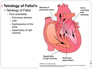  Tetralogy of Fallot’s
 Tetralogy of Fallot
 Four anomalies
 Pulmonary stenosis
 VSD
 Dextroposition of the
aorta
 Hypertrophy of right
ventricle
 