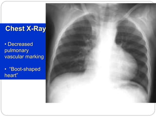 Chest X-Ray
• Decreased
pulmonary
vascular marking
• “Boot-shaped
heart”
 
