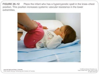 FIGURE 26–12 Place the infant who has a hypercyanotic spell in the knee–chest
position. This position increases systemic vascular resistance in the lower
extremities.
Jane W. Ball and Ruth C. Bindler
Child Health Nursing: Partnering with Children & Families
© 2006 by Pearson Education, Inc.
Upper Saddle River, New Jersey 07458
All rights reserved.
 