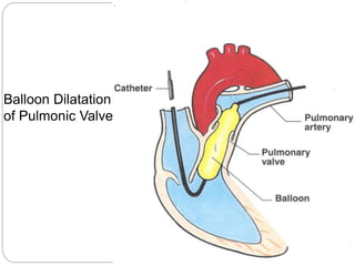 Balloon Dilatation
of Pulmonic Valve
 