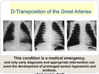 D-Transposition of the Great Arteries
This condition is a medical emergency,
and only early diagnosis and appropriate intervention can
avert the development of prolonged severe hypoxemia and
acidosis,
 