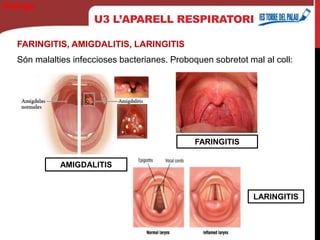 U3 L’APARELL RESPIRATORI
FARINGITIS, AMIGDALITIS, LARINGITIS
Són malalties infeccioses bacterianes. Proboquen sobretot mal al coll:
Biología
AMIGDALITIS
FARINGITIS
LARINGITIS
 