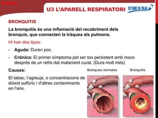 U3 L’APARELL RESPIRATORI
BRONQUITIS
La bronquitis és una inflamació del recobriment dels
bronquis, que connecten la tràquea als pulmons.
Hi han dos tipos:
- Aguda: Duren poc.
- Crònica: El primer símptoma pot ser tos persistent amb mocs
després de un refre dat malament curat. (Dura molt més)
Causes:
El tabac, l’agreuja, o concentracions de
diòxid sulfúric i d'altres contaminants
en l'aire.
Biología
 
