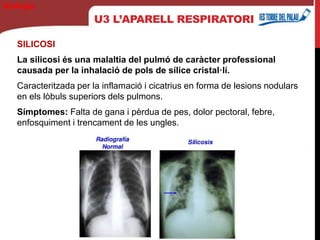U3 L’APARELL RESPIRATORI
SILICOSI
La silicosi és una malaltia del pulmó de caràcter professional
causada per la inhalació de pols de sílice cristal·lí.
Caracteritzada per la inflamació i cicatrius en forma de lesions nodulars
en els lòbuls superiors dels pulmons.
Símptomes: Falta de gana i pèrdua de pes, dolor pectoral, febre,
enfosquiment i trencament de les ungles.
Biología
 