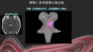 課題3. 医用画像の描出能
知識（正常解剖3DCG）と医用画像との融合
脳幹部海綿状血管腫
 