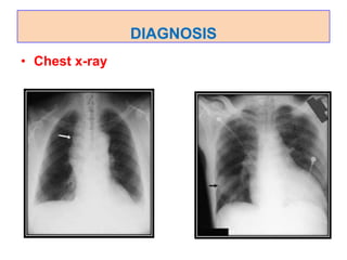 DIAGNOSIS
• Chest x-ray
 