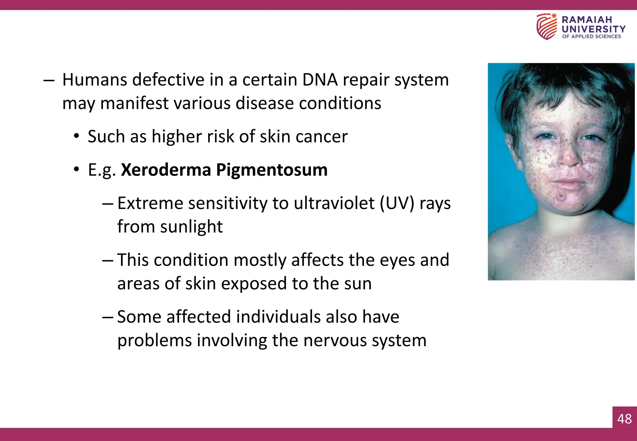 48
– Humans defective in a certain DNA repair system
may manifest various disease conditions
• Such as higher risk of skin cancer
• E.g. Xeroderma Pigmentosum
– Extreme sensitivity to ultraviolet (UV) rays
from sunlight
– This condition mostly affects the eyes and
areas of skin exposed to the sun
– Some affected individuals also have
problems involving the nervous system
 