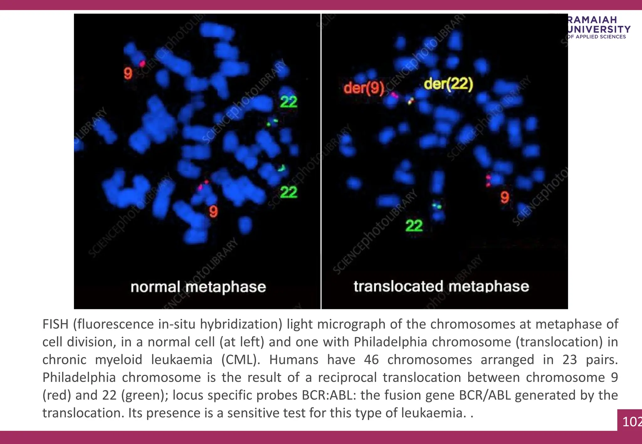 102
102
FISH (fluorescence in-situ hybridization) light micrograph of the chromosomes at metaphase of
cell division, in a normal cell (at left) and one with Philadelphia chromosome (translocation) in
chronic myeloid leukaemia (CML). Humans have 46 chromosomes arranged in 23 pairs.
Philadelphia chromosome is the result of a reciprocal translocation between chromosome 9
(red) and 22 (green); locus specific probes BCR:ABL: the fusion gene BCR/ABL generated by the
translocation. Its presence is a sensitive test for this type of leukaemia. .
 