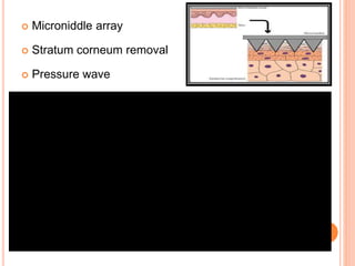  Microniddle array
 Stratum corneum removal
 Pressure wave
 