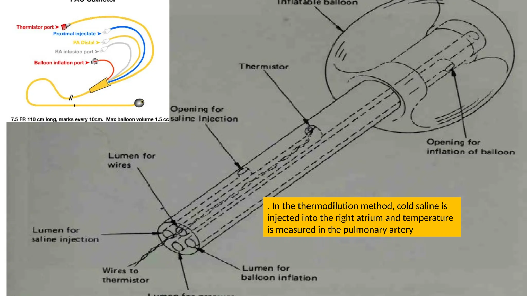 . In the thermodilution method, cold saline is
injected into the right atrium and temperature
is measured in the pulmonary artery
 