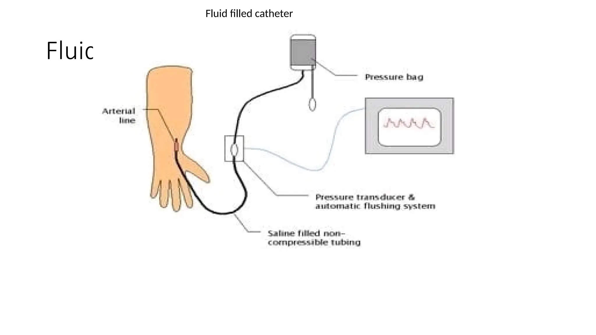 Fluid filled catheter
Fluid filled catheter
 