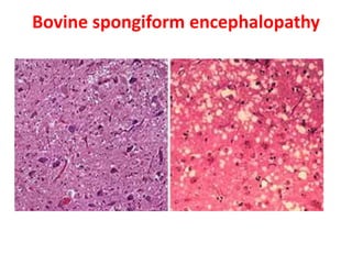 Bovine spongiform encephalopathy
 