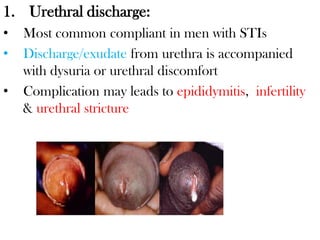 1. Urethral discharge:
• Most common compliant in men with STIs
• Discharge/exudate from urethra is accompanied
with dysuria or urethral discomfort
• Complication may leads to epididymitis, infertility
& urethral stricture
 