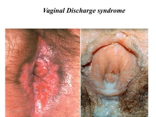 Vaginal Discharge syndrome
15
3/28/2024 STI
 