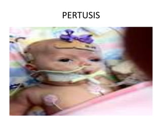 PERTUSIS
 
