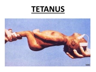 TETANUS
 